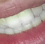 스노우 치아<b>미백</b> ㅈㄴ 골때림