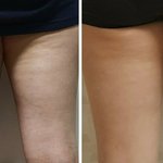 [댓글부탁해] 제 셀룰라이트 심한편인가요 ? 8kg 뺐는데도 ,...