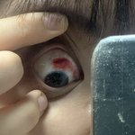 [댓글부탁해] 혐주의) 이거 <b>실핏줄</b> 타진거야?