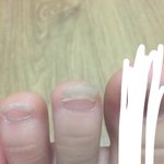 <b>발톱</b> 다시 붙였어