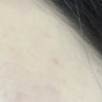 [댓글부탁해] 얘들아 여드름 <b>흉터</b>