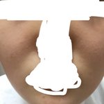 교정 후 <b>팔자</b>주름