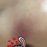 여드름짜다가 <b>피멍</b> ㅋㅋㅋㅋㅋ