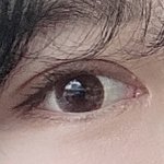 [드루와] 쌍수 붓기 원래 이렇게 오래가?