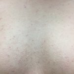 [댓글부탁해] 등<b>드름</b> 가<b>드름</b> 흉터 개심해 ㅠㅠㅠㅠ 짤주의