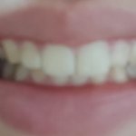 [댓글부탁해] 나 교정해야겠지...???