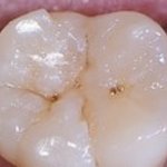 [19] 얘들아 나 <b>충치</b> 신경치료까지할까??