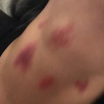 [19] 나 키스<b>마크</b> 어떻게없애?ㅠㅠㅠ