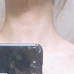 [댓글부탁해] 나 정도면 승모근 심한거야??