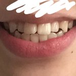 [댓글부탁해] 약혐 이 하얘지는법좀 ㅠㅠㅠ