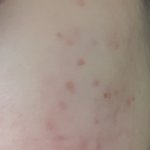 [댓글부탁해] (약혐주의)여드름흉터 <b>압출</b>받아야하나??ㅜㅜ