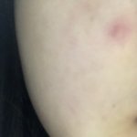 [댓글부탁해] 이거 <b>모낭염</b>임?