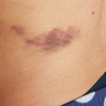 [꼭조언부탁] 한달전 맞은 한의원 침이 오늘 발견됐습니다.