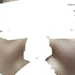 교정 후 <b>팔자</b>주름