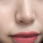 나 턱<b>필러</b>(윤곽)vs 입꼬리 추반좀