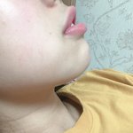 나 이정도면<b>무턱</b>임?