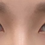 <b>짝눈</b> 많이 심한지..어떻게 교정해야하는지 봐주세요