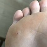 [댓글부탁해] 나 티눈밴드 붙여서 ㅈ됨;;;(약간혐)