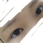 나 쌍수 <b>두달</b>찬데 붓기