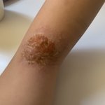 [댓글부탁해] 나 아토피 <b>Jonna</b> 심함(혐주의