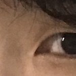 [이것좀봐줘] "쌍수 10개월 후기" +