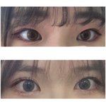 [드루와] 나 쌍수 전후 봐봐ㅋㅋㅋㅋㅋ