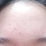 [19] <b>이</b>정도 여드름 잘자고 <b>물</b>먾이머시고 이러면 없어짐?