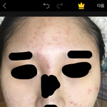 [댓글부탁해] 혐) 화장품으로 여드름 커버 불가능해?