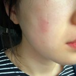 [도와주세요] 레이저<b>제모</b> 후 얼굴에 흉터? 화상이  생겼어요 ㅠㅠㅠ...