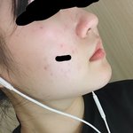 [댓글부탁해] 이<b>정도</b>면 <b>피부</b> 얼마나 안좋은거냐...