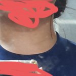 [댓글부탁해] 나 승모근 심해? 추반해주라