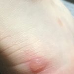 [드루와] 얘들아 이거 <b>물집</b> 맞지? 사진 징그러워