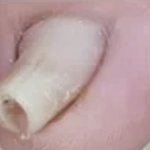 [19] <b>내성</b>발톱 이렇게나고 1억받으면 추반