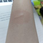 [댓글부탁해] 쓰바 데였는데 이거 어떡행??