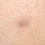 1일차 <b>코옆</b>에난 여드름흉터 노스카나로 없애본다