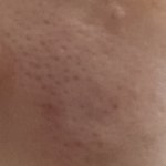 혐주의) 모공 <b>어떠</b>케 없애 ㅠㅠㅠㅠㅠ