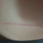 [댓글부탁해] <b>시밤</b> 이런 흉터 어떻게 없애??