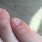 얘들아 발에 <b>물집</b> 잡혔는데 터트려야해..?