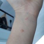 [드루와] <b>물집</b> 터트릴까 말까