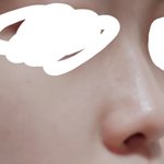 얘들아 코수술할까...?