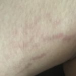 [댓글부탁해] 너네 혹시 튼살 있니