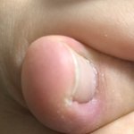 [조언부탁해] <b>내성</b>발톱이야..?