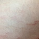 나 튼살 진짜 심함..