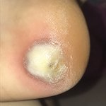 [댓글부탁해] 혐오))) 티눈 <b>물집</b>잡힌건지좀 봐주라