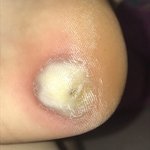 [댓글부탁해] 혐오)) 이거 <b>물집</b> 잡힌거야? 티눈