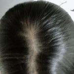 [드루와] 야미친 나 <b>탈모</b>인가..?