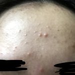 [약혐] 내 이마 여드름 볼 사람ㅋㅋㅋ 멘탈<b>터짐</b>