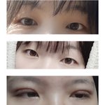 <b>쌍수</b> 1년째 후기