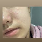 [드루와] 내피부 <b>소생</b>가능?