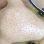내가 장담하는데 나보다 블랙<b>헤드</b> 많은애 없을듯